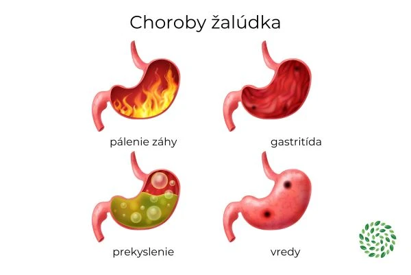 Ilustrace běžných nemocí žaludku s názvy v češtině