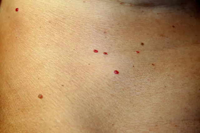 Červené pihy na lidské kůži.